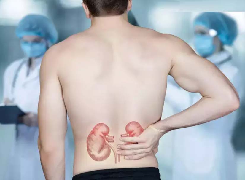 5 early symptoms of kidney stones you should not miss